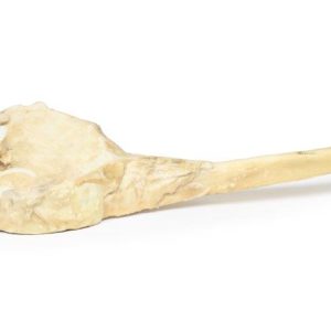Osteosarcoom in Dijbeen, 3D Print