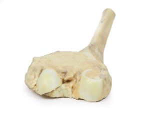 Osteosarcoom in Dijbeen, 3D Print