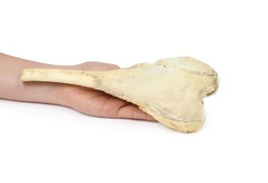 Osteosarcoom in Dijbeen, 3D Print