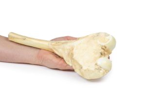 Osteosarcoom in Dijbeen, 3D Print