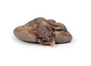 Papillair Overgangscelcarcinoom in het Nierbekken, 3D Print