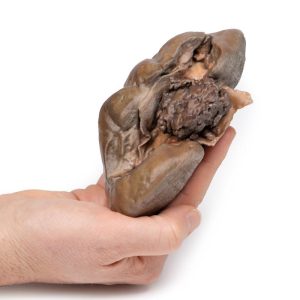 Papillair Overgangscelcarcinoom in het Nierbekken, 3D Print
