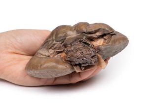 Papillair Overgangscelcarcinoom in het Nierbekken, 3D Print