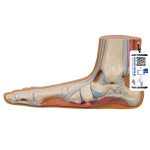 Platvoet (Pes planus)