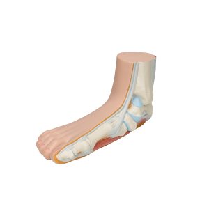 Platvoet (Pes planus)