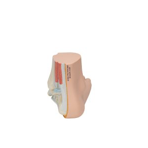Platvoet (Pes planus)