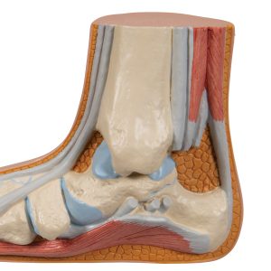 Platvoet (Pes planus)