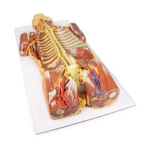 Posterieure Lichaamswand/Ventrale Diepe Dissectie, 3D Print