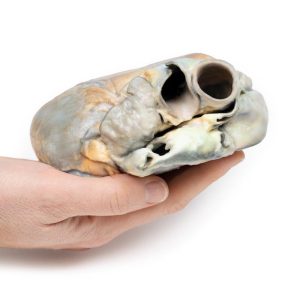 Rechterventrikelhypertrofie, 3D Print
