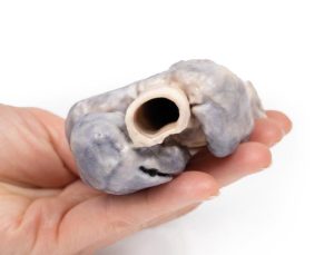 Retrosternaal Struma, 3D Print