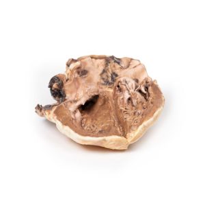 Reumatische Endocarditis, 3D Print