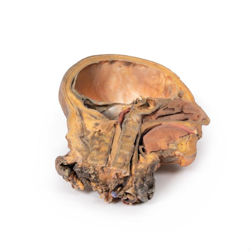 Sagittale Doorsnede Hoofd en Nek met Dissectie, 3D Print