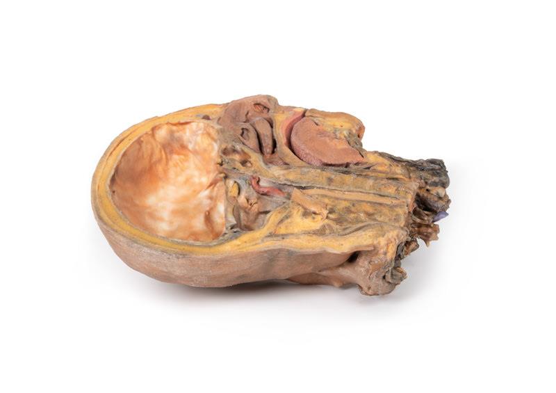 Sagittale Doorsnede Hoofd en Nek met Dissectie, 3D Print