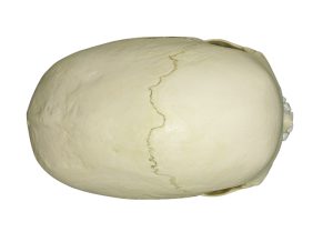 Scaphocephalische Schedel