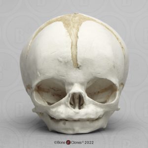Schedel foetus 32 weken