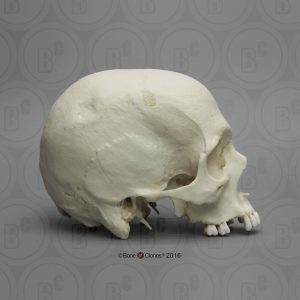 Schedelmodel met Hamerinslag