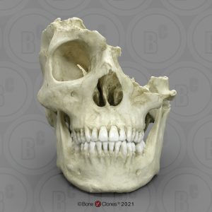Schedelmodel met Machete Wond