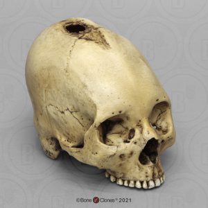 Schedelmodel Trepanatie