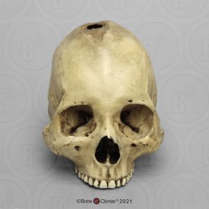 Schedelmodel Trepanatie