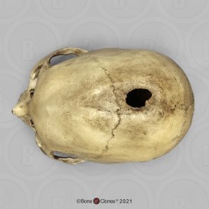 Schedelmodel Trepanatie