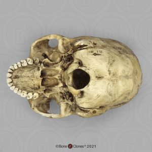 Schedelmodel Trepanatie