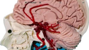 Slagader Model met Aneurysma's