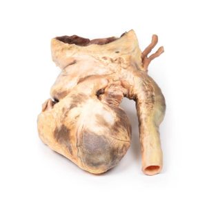 Syfilitisch Aneurysma, 3D Print