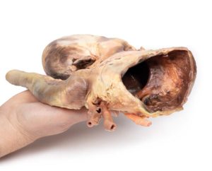 Syfilitisch Aneurysma, 3D Print
