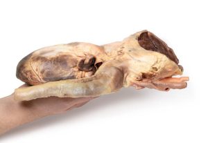Syfilitisch Aneurysma, 3D Print