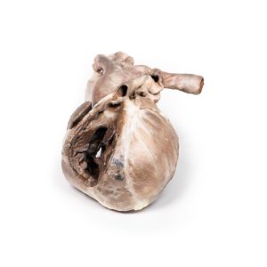 Tetralogie van Fallot, 3D Print