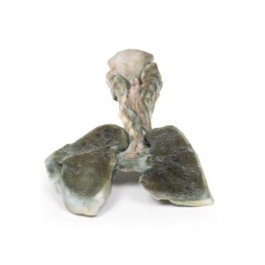 Tracheoesofageale Fistel en Oesofagusatresie, 3D Print