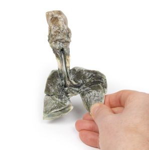 Tracheoesofageale Fistel en Oesofagusatresie, 3D Print