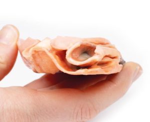 Traumatische Aorto-Oesofageale Fistel, 3D Print