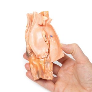Traumatische Aorto-Oesofageale Fistel, 3D Print