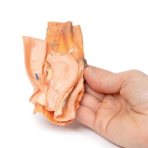 Traumatische Aorto-Oesofageale Fistel, 3D Print