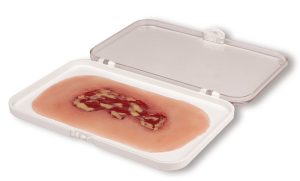 Veneuze Beenzweer Wond, Exsudatiefase