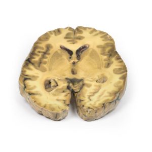 Ventriculitis, secundair aan bloedvergiftiging, 3D Print