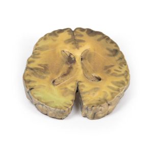 Ventriculitis, secundair aan bloedvergiftiging, 3D Print