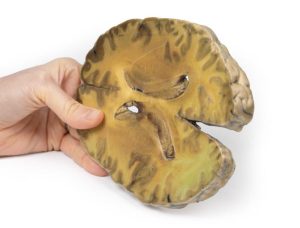 Ventriculitis, secundair aan bloedvergiftiging, 3D Print