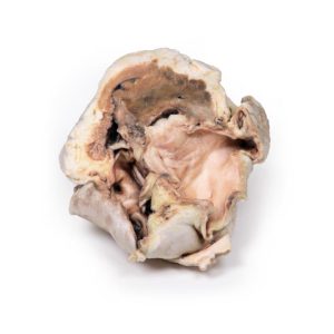 Verkalkte Aortaklepstenose Bicuspide Aortaklep, 3D Print