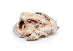 Verkalkte Aortaklepstenose Bicuspide Aortaklep, 3D Print
