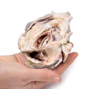 Verkalkte Aortaklepstenose Bicuspide Aortaklep, 3D Print