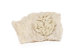 Villeus Adenoom in Dikke Darm, 3D Print