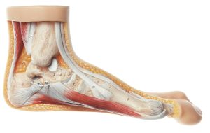 Voet met Hallux valgus