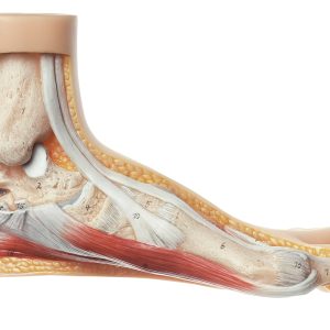Voet met Hallux valgus