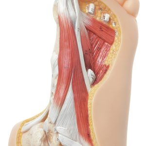 Voet met Hallux valgus