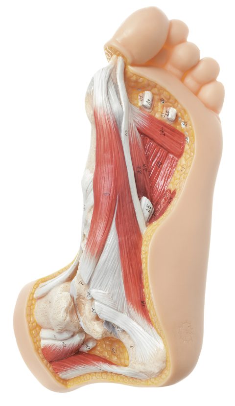 Voet met Hallux valgus