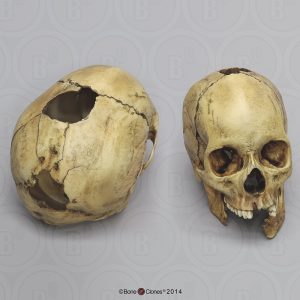 Vrouwelijk Schedelmodel met Schotwonden