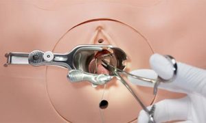 Vulva met geïntegreerde fistels voor Uitgebreide Gynaecologische Vaardigheidstrainer