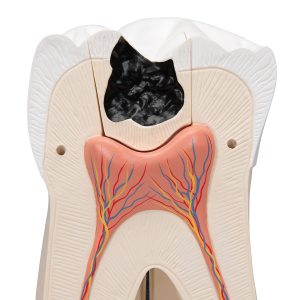 Ware kies met cariës,15-maal vergroot model, 6-delig